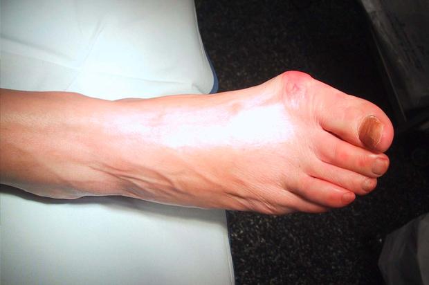 Bunions, those unwelcome, painful bumps that form on the joint at the base of your big toe, are probably one of the most common foot problems that no one wants to talk about. Cherrywood Foot Care can resolve all your bunion issues to get you back on your feet again. (WikiMedia Commons) 