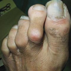 Hammertoe: Everything You Need To Know