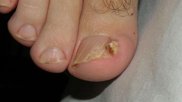 Ingrown Toenails: Finding A Cure - Cherrywood Foot Care