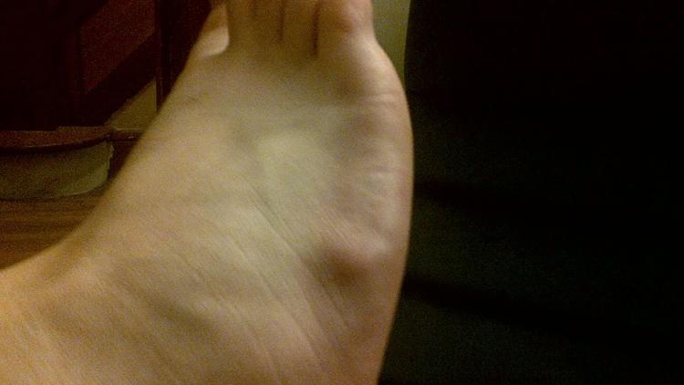 Ganglion cyst on foot: Pictures, cause, symptoms, and treatment