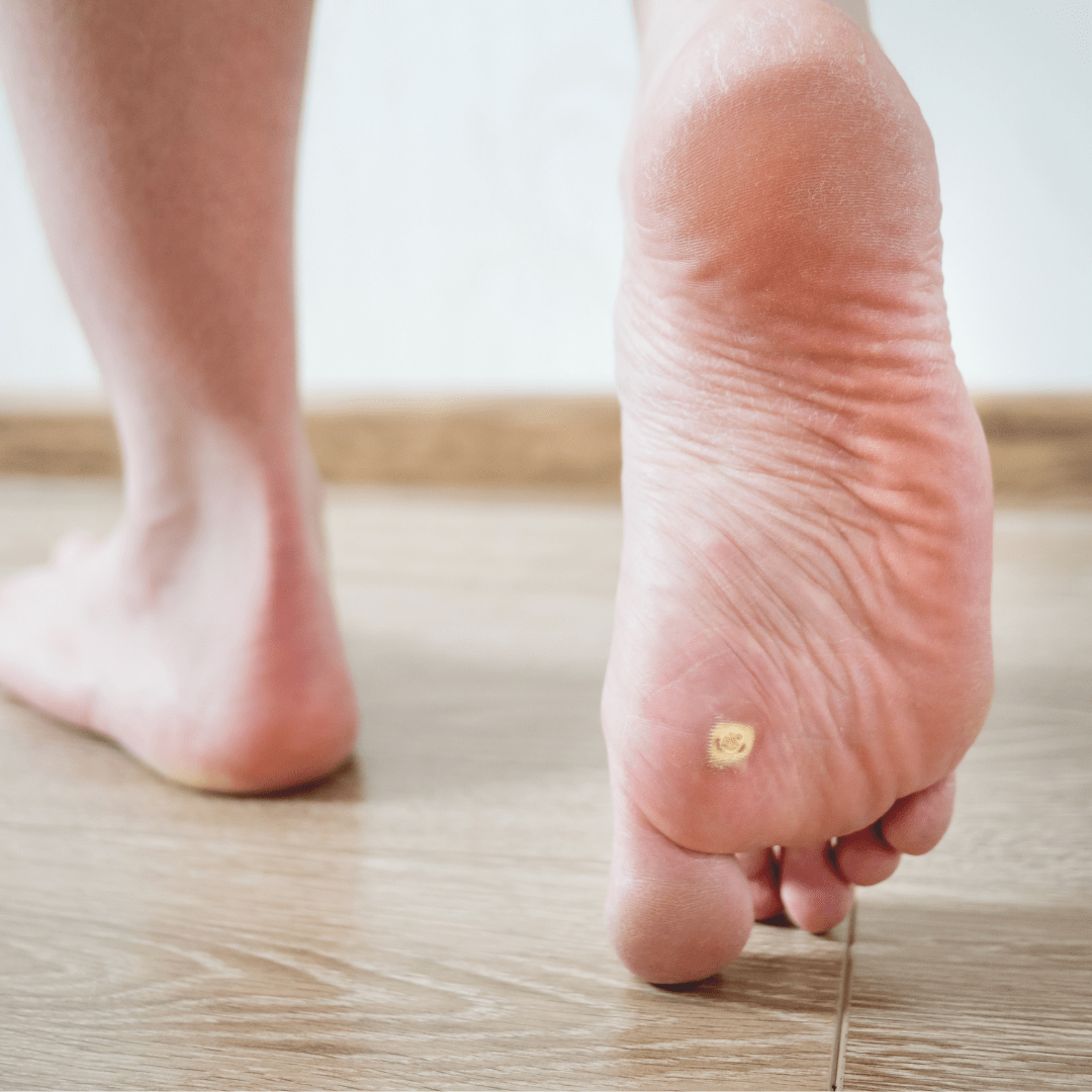 Foot Doctor Massapequa - Way To Prevent Foot Warts