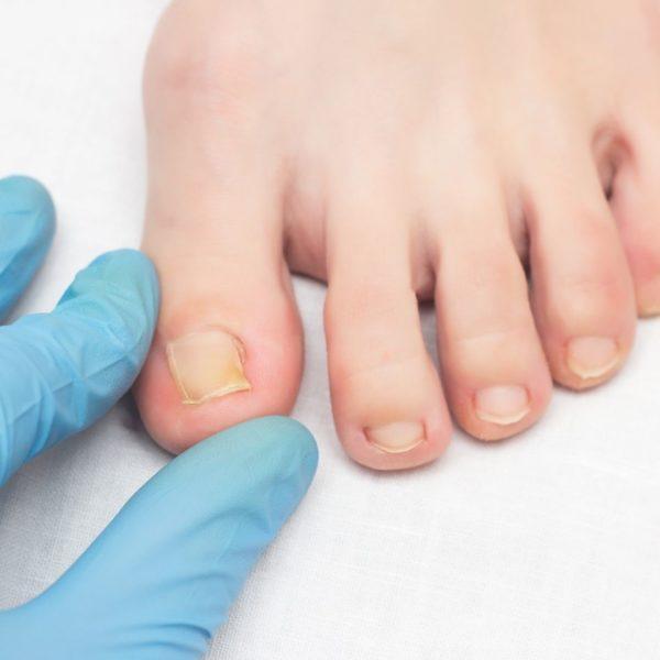 ingrown toenail treatment on Long Island