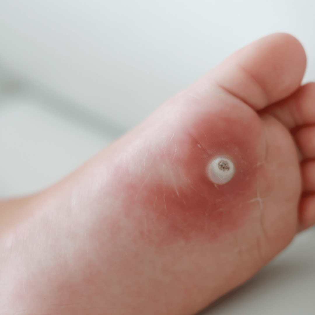 Wart Treatment Cherrywood Foot Care