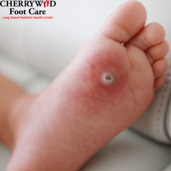 Plantar wart removal near East Meadow NY