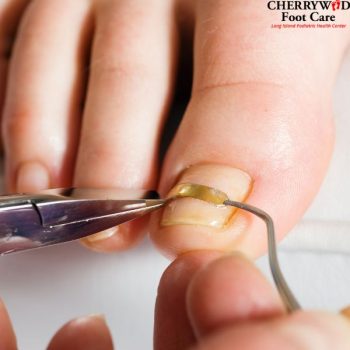 Toenail fungus laser treatment near East Meadow