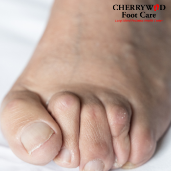 Hammertoe treatment near Amityville NY