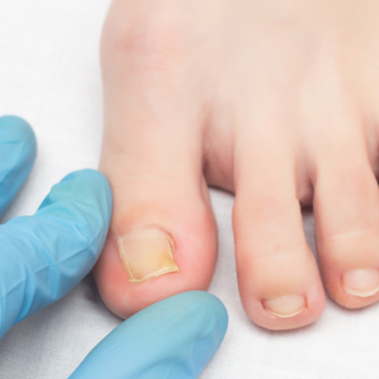 Toenail fungus laser treatment near Amityville NY