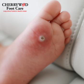 Foot wart treatment Nassau County