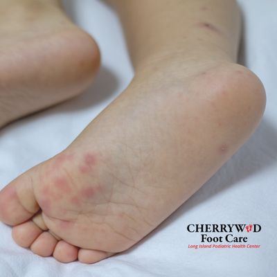 Cherrywood Foot Care Image Replacement (44)