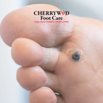 Podiatrist near Hempstead NY cherrywood (2)