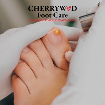 laser nail fungal treatment levittown cherrywood 1