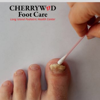 laser nail fungal treatment levittown cherrywood (3)