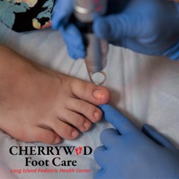laser nail fungal treatment levittown cherrywood