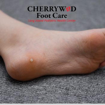 laser nail fungal treatment levittown cherrywood (5)