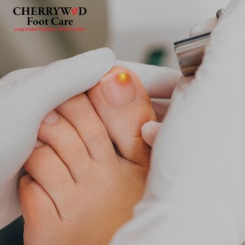 cherrywood image replacement plantar fascitiis nassau county